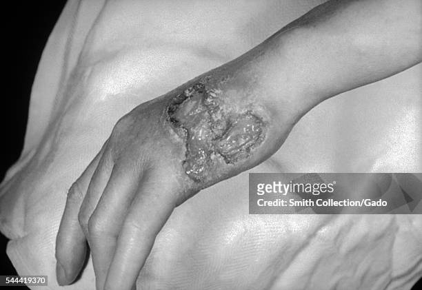 Photograph of a patient with tertiary syphilis resulting in gummatous lesions on the dorsal surface of the left hand, 1971. Gummatous lesions due to...