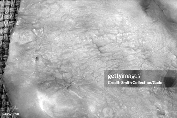 Syphilis of the aorta, or aortitis, during the tertiary stage of the disease, 1971. Syphilitic aortitis causes markedly irregular wrinkling of the...