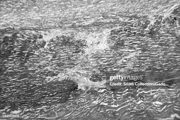 This photomicrographic section of the myocardium reveals a fibrous plaque as a result of syphilitic aortitis, 1971. The elastic fibers of the tunica...