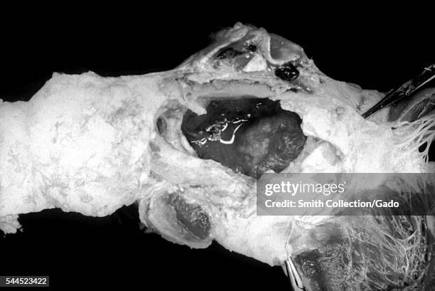 Ruptured aortic aneurysm due to cardiovascular syphilis, 1971. This image shows a large ruptured, fusiform aneurysm involving the ascending portion...