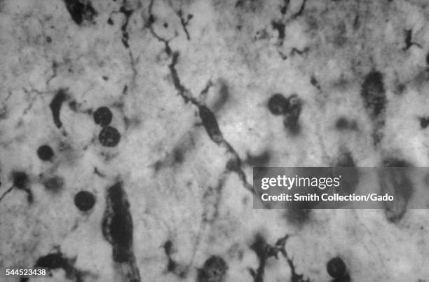 Elongated microglia due to untreated syphilis leading to general paresis known as paretic neurosyphilis, 1971. Neurosyphilis is a slowly progressive...