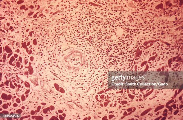 Photomicrograph of a syphilitic microgumma of the heart, 1971. Microgumma seen in the heart, possess a central zone of necrosis surrounded by large...