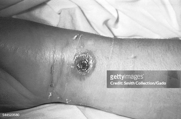 Cutaneous anthrax lesion on the arm of a 50 year old female, 1971. This 50 year old female had been a carder in a wool factory for 6 years. This...