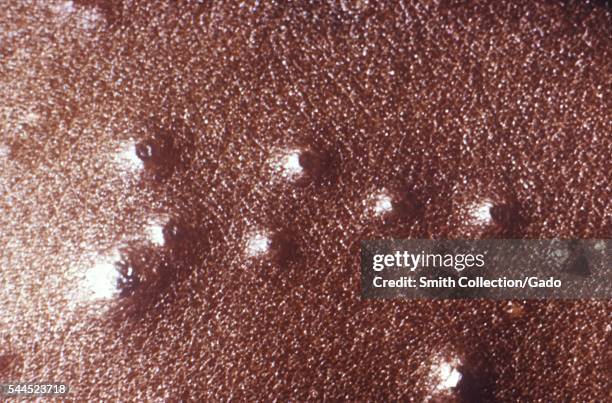 Photograph of smallpox lesions on the skin of the arm, 1972. Close-up photograph of smallpox lesions seen on the deltoid area of the arm during the...