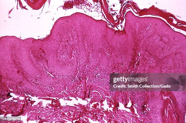 This pinta lesion, stained using the hematoxylin-eosin technique, is caused by the bacterium Treponema carateum, magnification 100X, 1970. This...