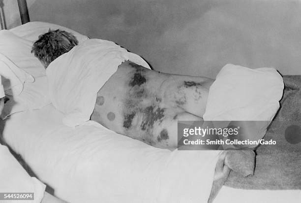 Isolated male patient diagnosed with Crimean-Congo hemorrhagic fever , 1969. Crimean-Congo Hemorrhagic Fever is a tickborne hemorrhagic fever with...