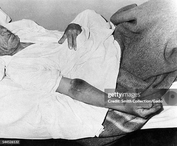 Isolated male patient diagnosed with Crimean-Congo hemorrhagic fever , 1969. Crimean-Congo Hemorrhagic Fever is a tickborne hemorrhagic fever with...