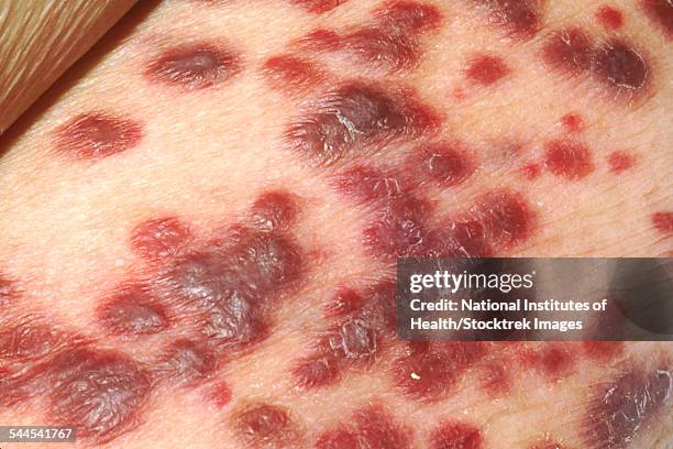 kaposis sarcoma on the skin of an aids patient. - aids patient stockfoto's en -beelden