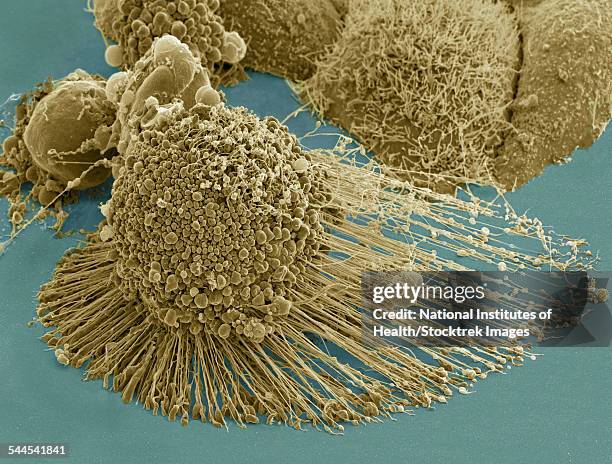 scanning electron micrograph of an apoptotic hela cell. - hela cells foto e immagini stock