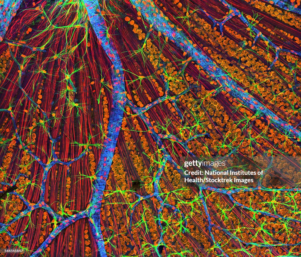 Neurofibromatosis, a genetic disorder of the nervous system.