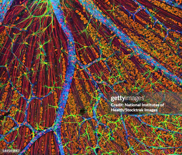 neurofibromatosis, a genetic disorder of the nervous system. - neurofibromatose stock-fotos und bilder