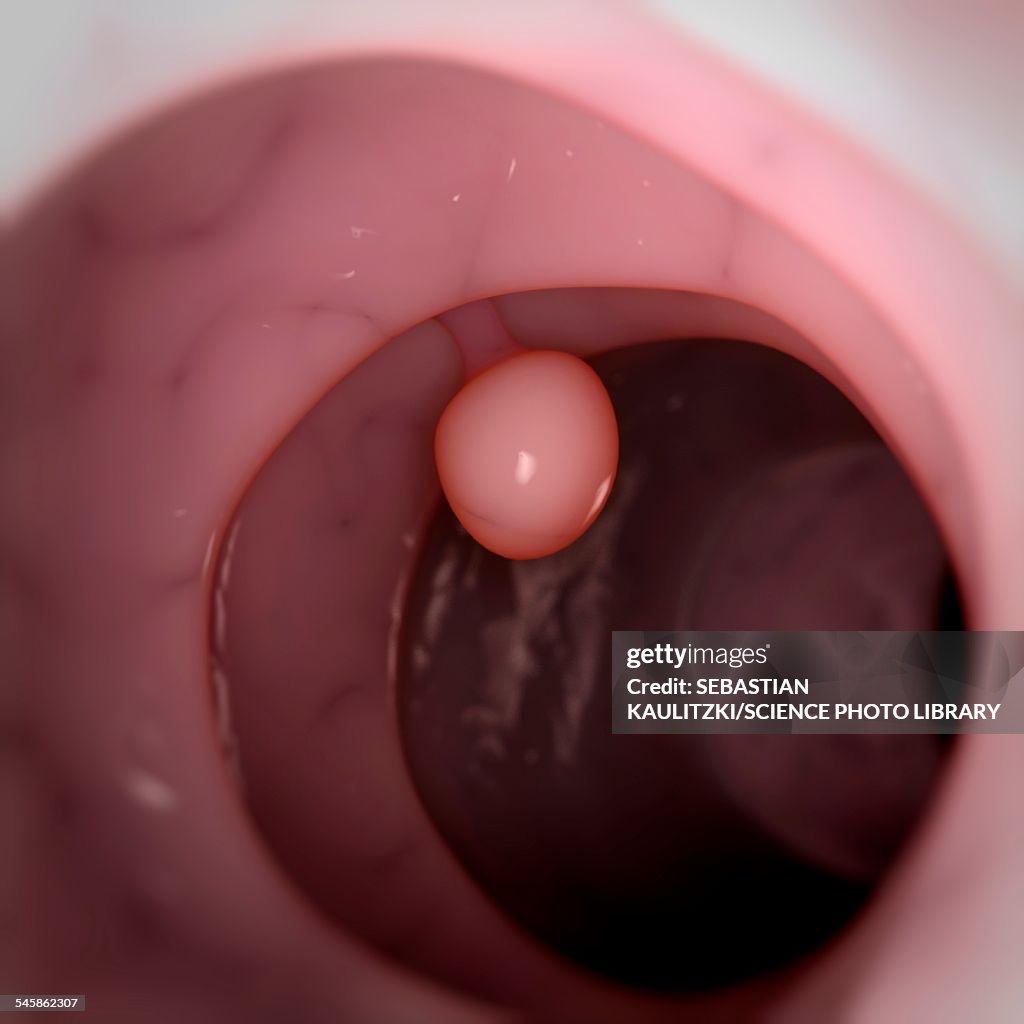 Complex Polyp Image Human Colon Polyp Illustration High-Res Vector Graphic - Getty Images