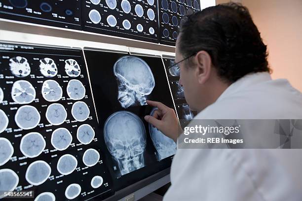 doctor pointing to skull xray image on lightbox - radiogram photographic image stock-fotos und bilder