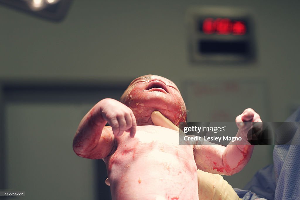 Newborn baby born by Caesarian