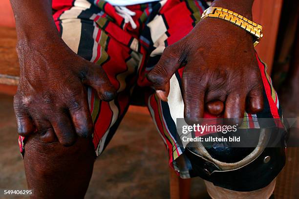 Nigeria, Ossiomo. Leper colony, supplied by the German Leprosy and Tuberculosis Relief Association .