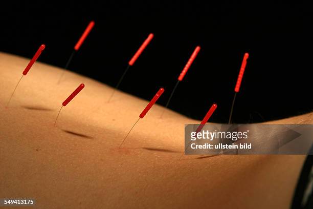 Acupuncture, TCM