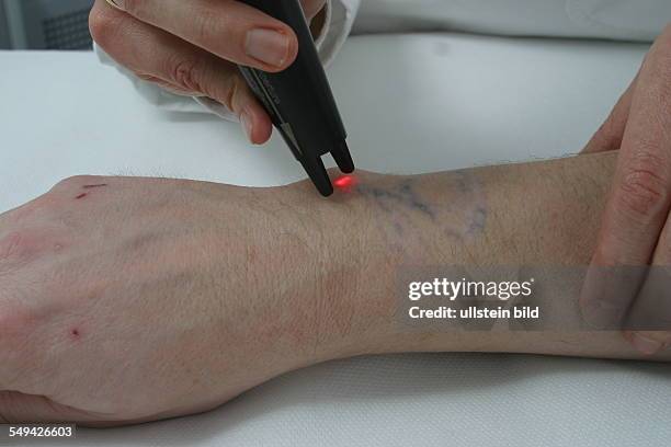 Germany, Essen, medicine physicist and non-medical practitioner Holger May, manager of the Laser Forum Essen. A patient during a laser treatment....