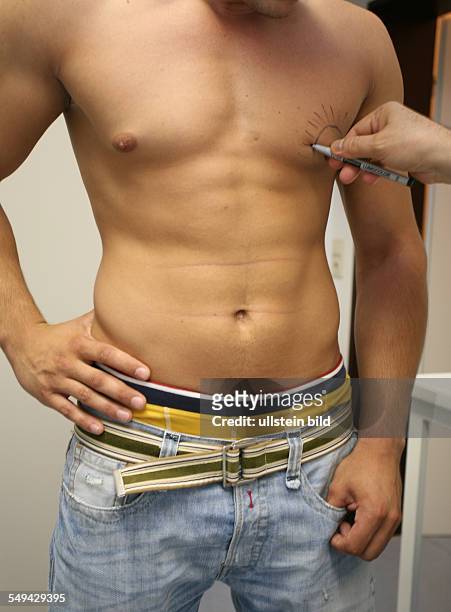 Deu, Germany, Recklinghausen: Sebastian L., 23 years old. He takes anabolic steroids since 3 or 4 yaers. Examination of the nipples through Dr....