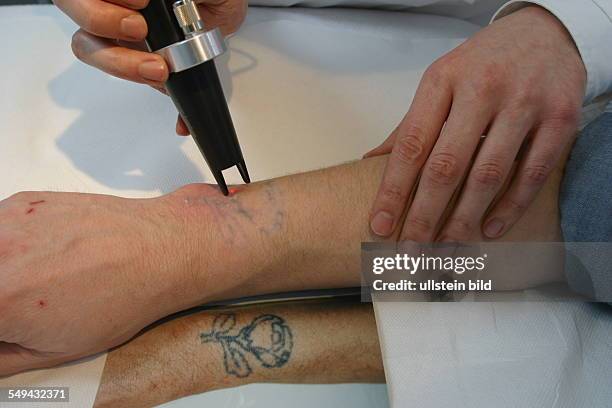 Germany, Essen, medicine physicist and non-medical practitioner Holger May, manager of the Laser Forum Essen. A patient during a laser treatment....