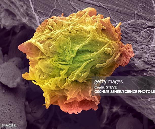 lymphoma cancer cell, sem - coloured scanning electron micrograph stock illustrations