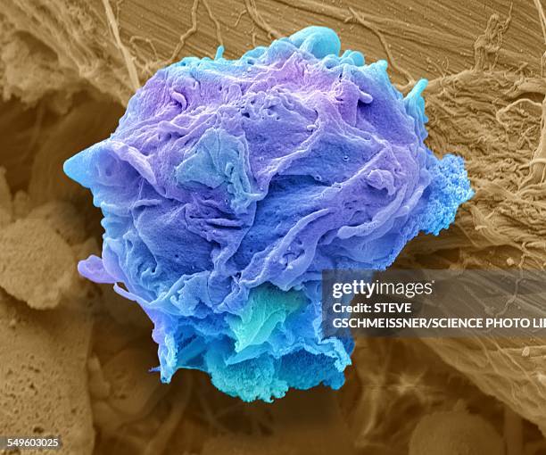 lymphoma cancer cell, sem - electron microscope micrographs stock illustrations