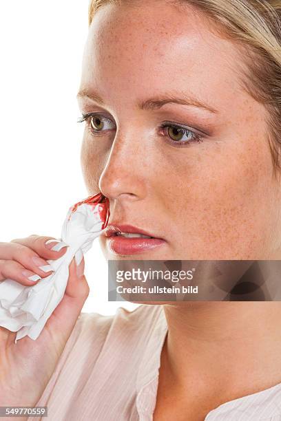 Eine junge Frau blutet aus ihrer Nase. Stoppt Nasenbluten mit einem Taschentuch