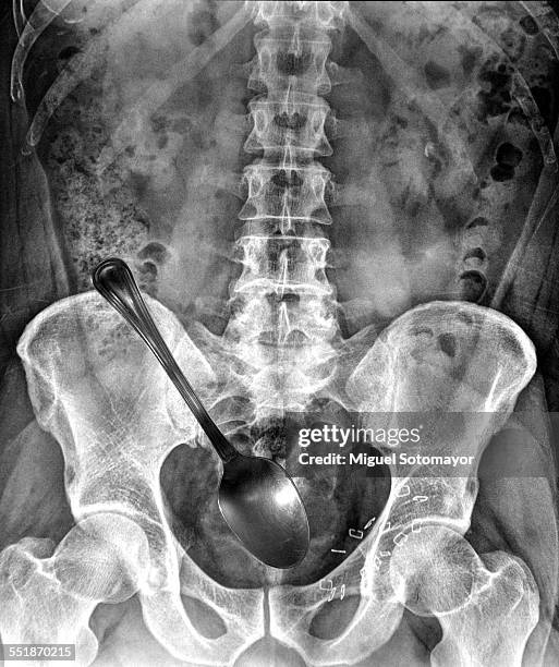 radiography. merging mediums - inguinal hernia stock pictures, royalty-free photos & images