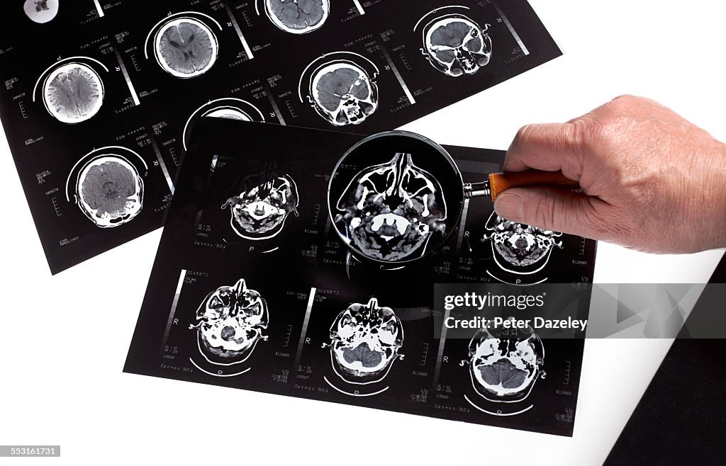Dementia bran scan research