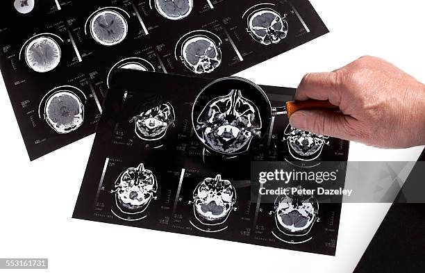 dementia bran scan research - demência imagens e fotografias de stock