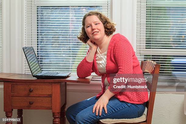 young woman with autism using her laptop - hemangioma - fotografias e filmes do acervo