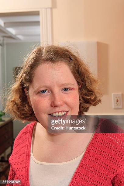 smiling portrait of a young woman with autism - hemangioma - fotografias e filmes do acervo