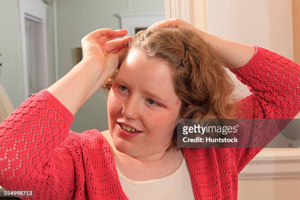 young woman with autism fixing her hair - hemangioma - fotografias e filmes do acervo