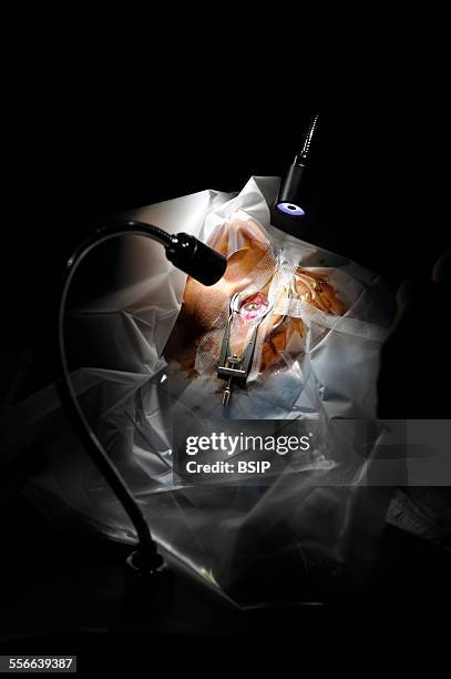 Eye Laser Surgery, Refractive eye surgery at the Adolphe de Rothschild Ophthalmology Foundation in Paris, Eye surgery using a femtosecond laser and...