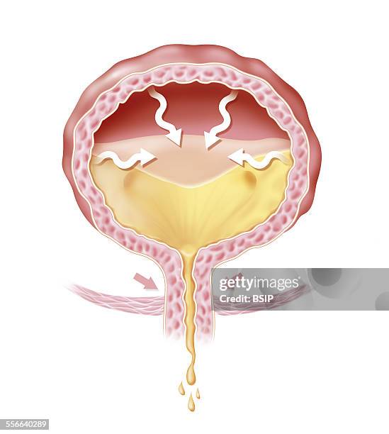 Bladder Pnet 69 Bladder Wall Stock Photos, High-Res Pictures, and Images - Getty Images