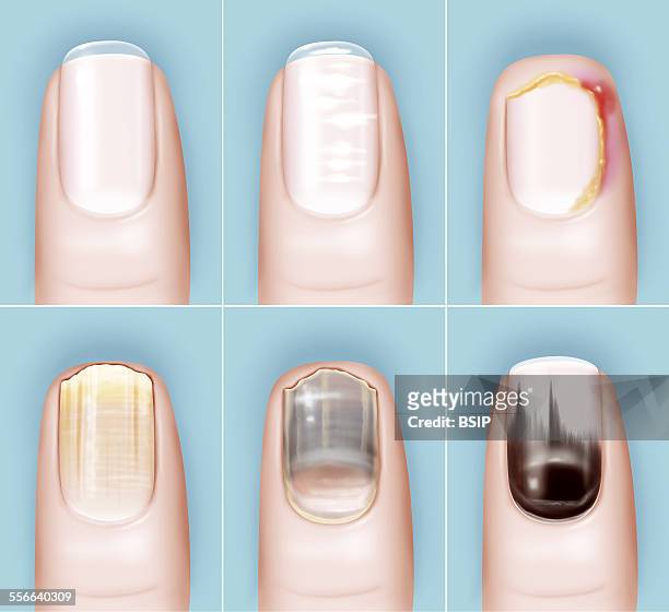 Pathology Of The Nail, Drawing, Illustration of the various nail pathologies. From left to right, top to bottom healthy nail, ridged nail due to the...