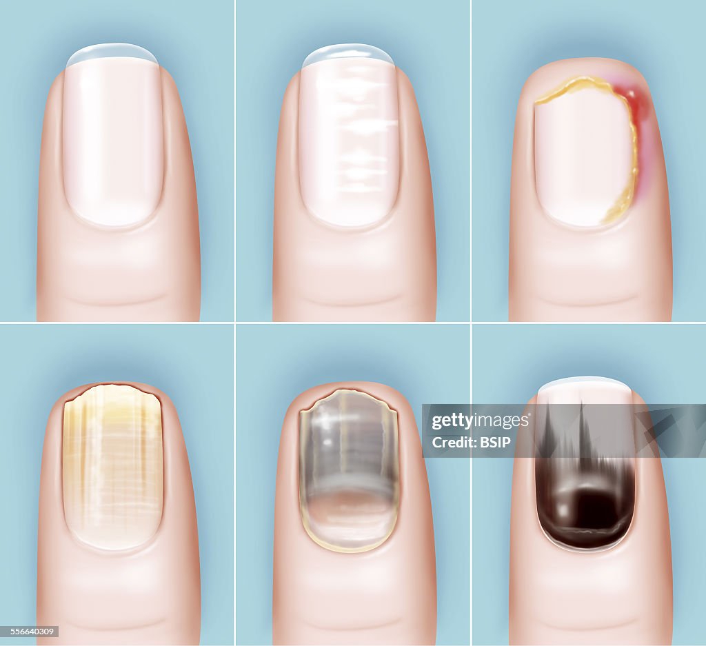 Pathology Of The Nail, Drawing