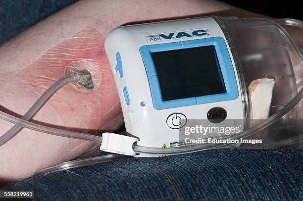 Wound VAC hooked to an adult males leg that will not heal after a cancerous tumor was removed