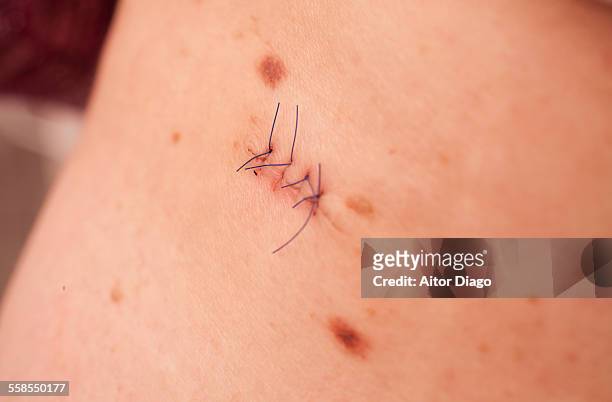 wound´s stitches. close up. - hospital acquired infection stock pictures, royalty-free photos & images