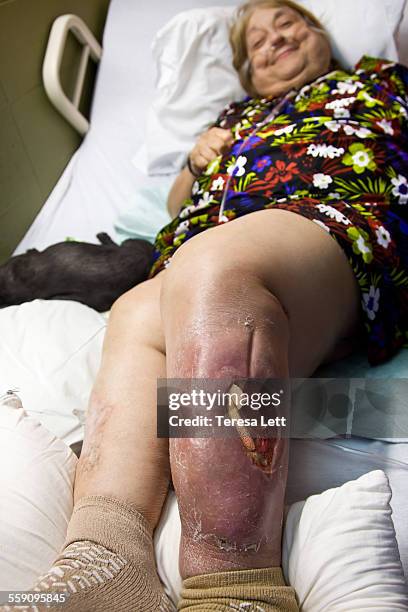 woman with large open wound on leg - old lady nightgown stock pictures, royalty-free photos & images