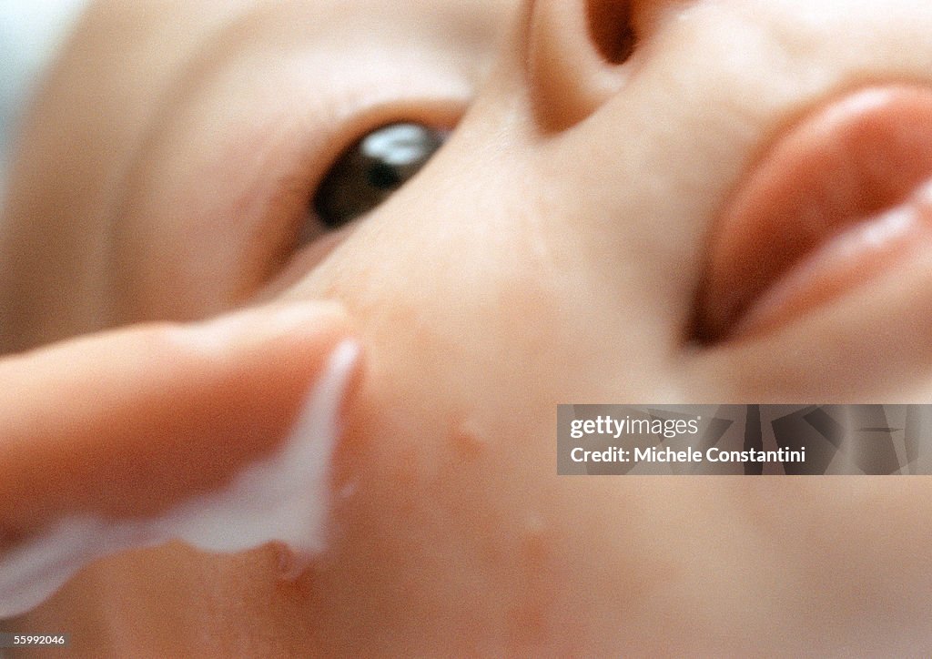 Baby having lotion applied to pimples on face, extreme close-up