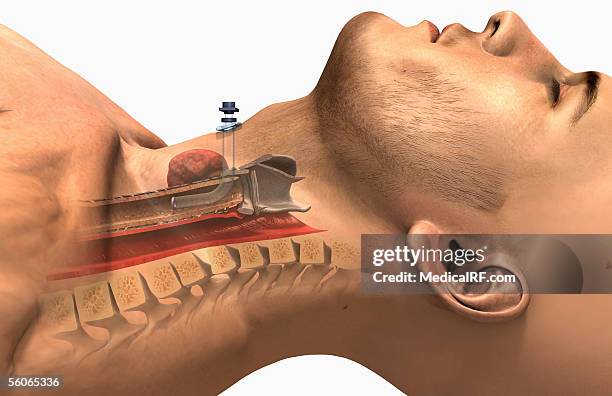 ilustrações de stock, clip art, desenhos animados e ícones de a lateral view of the tracheostomy procedure. - deitado de costas