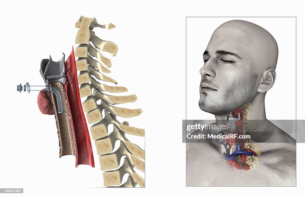 A three quarter lateral view of the tracheostomy procedure.