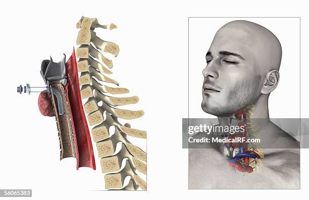 a three quarter lateral view of the tracheostomy procedure. - pharynx stock illustrations