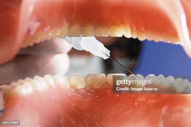dental operation - gencive photos et images de collection