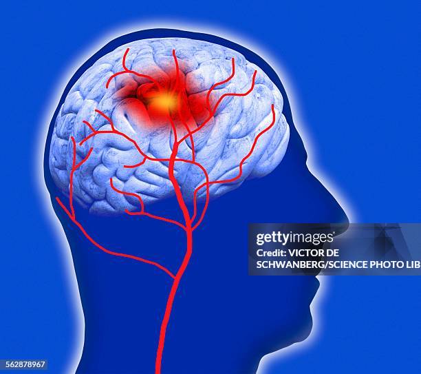 ilustrações, clipart, desenhos animados e ícones de human brain showing stroke - derrame cerebral