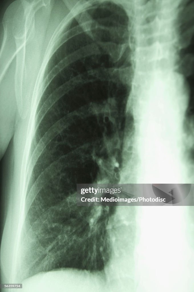 X-ray of human chest