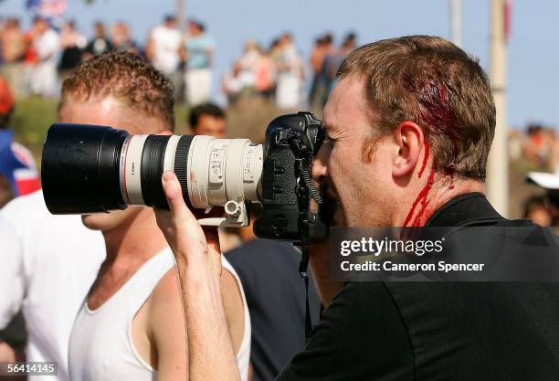 Photographer is seen with head wounds after youths threw glass bottles at police and a passing ambulance during unrest at Cronulla beach December 11,...