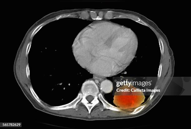 image from a co-registered pet-ct study from dual modality scanner. patient with multiple metastatic lesions in liver & lung. pet data superimposed over ct scan axial slice through lung metastases - pet scan stock-fotos und bilder