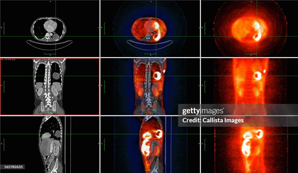 Image from co-registered PET-CT study from dual modality scanner. Patient with multiple metastatic lesions in liver & lung. PET data superimposed over CT scan axial slice through lung metastases