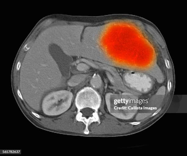 image from a co-registered pet-ct study from dual modality scanner. patient with multiple metastatic lesions in liver & lung. pet data superimposed over ct scan axial slice through liver metastases - pet food foto e immagini stock